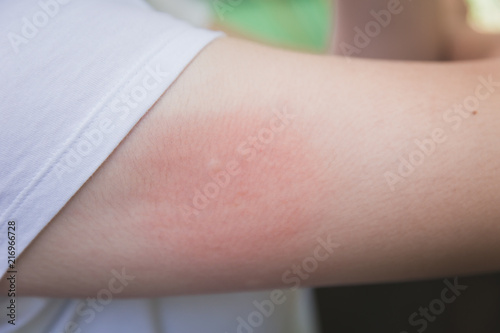 irritation skin allergy by mosquitoes insect bite or sting red infection from itching tickle or scratching