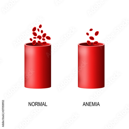 blood of healthy human and blood vessel with anemia.