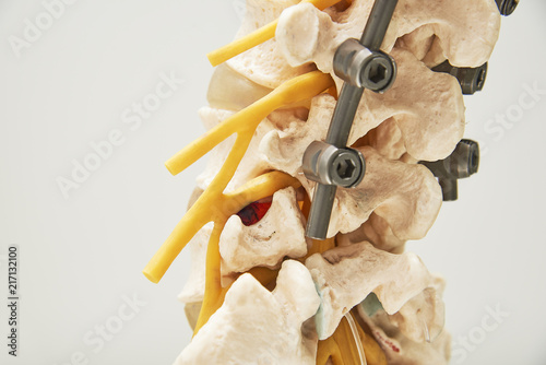 Model of instrument fixation of human lumbar spine model
