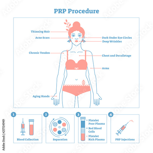 PRP Procedure vector illustration graphic diagram, cosmetology procedure scheme. Women beauty and skincare. Line style clean design poster with labels.