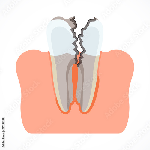 Stages of tooth decay with caries. Dentistry and oral care. Flat vector cartoon illustration. Objects isolated on white background. photo