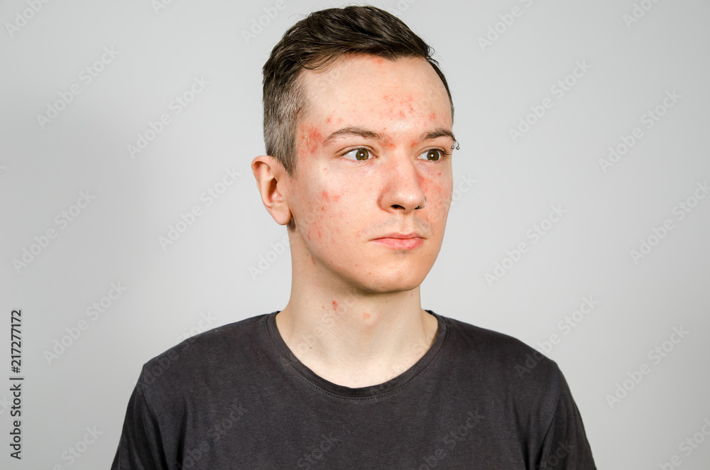 Fototapeta premium Portrait of young guy with allergy, with redness face