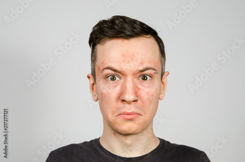 Portrait of young guy with allergy, with redness face