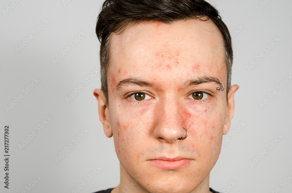 Portrait of young guy with allergy, with redness face. Close-up. Portrait of young guy with allergy, with redness face. Close-up.