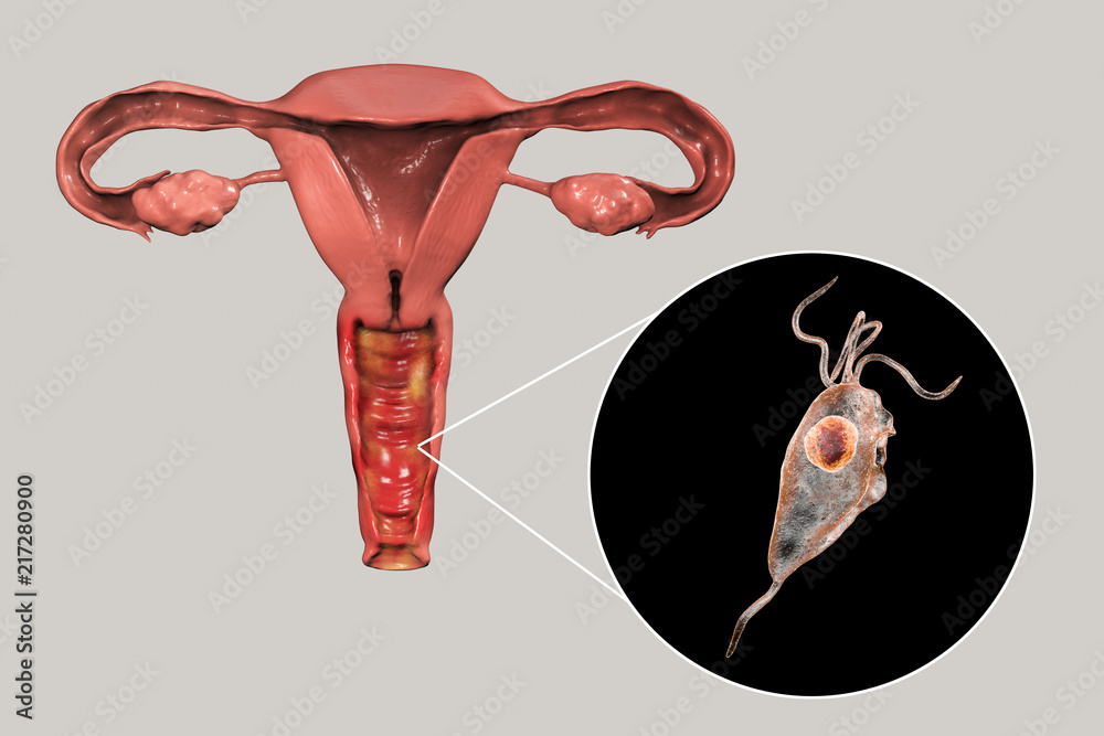 Female trichomoniasis, 3D illustration showing vaginitis and closeup