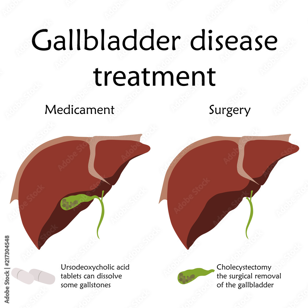 Gallbladder disease treatment, medicament, surgery, inflammation