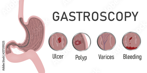 Gastroscopy endoscopic procedure and indications