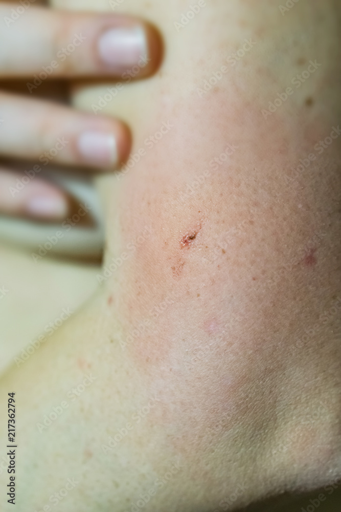 Close-up of a young woman's hand biting an insect, having an allergic reaction, redness, itching, swelling and hardening around the bite. Close-up of a young woman's hand biting an insect, having an allergic reaction, redness, itching, swelling and hardening around the bite.