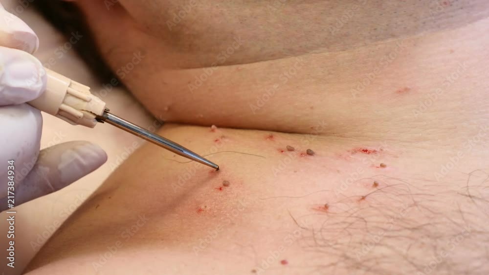 Surgery concept. Papillomas removal. Close up. Doctor removing mole in surgical procedure by burning it with medical tools and equipment on male body Surgery concept. Papillomas removal. Close up. Doctor removing mole in surgical procedure by burning it with medical tools and equipment on male body