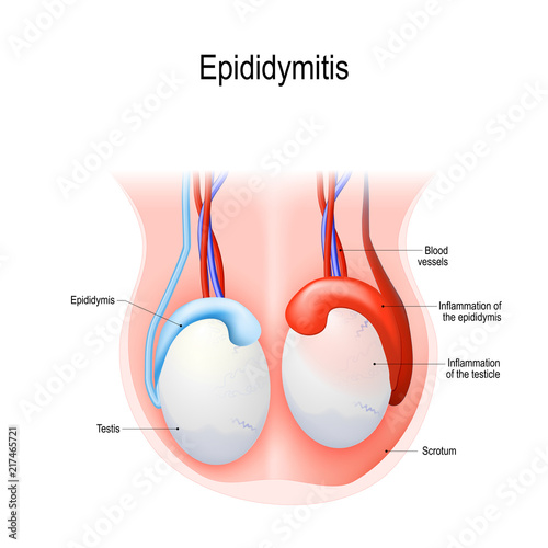 Epididymitis is inflammation of the epididymis of the testicle.