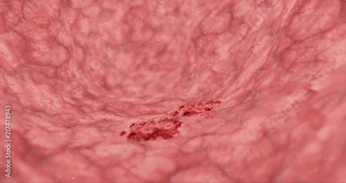 4k Cancer Tumor expanding cancer growing cells lymphoma carcinoma cancers over healthy tissue CRISPR gene editing  3d rendering 