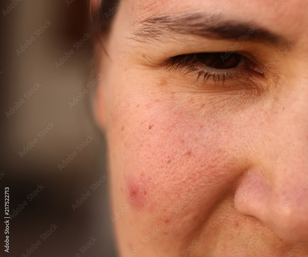 Girl with problematic skin. Acne. Girl squinting eye. 