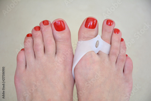 feet wearing hallux valgus orthopedic pads on thumb toes photo
