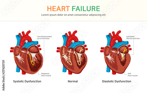Heart failure or congestive heart failure photo