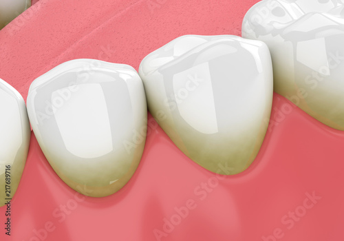 3d render of teeth with plaque and tartar photo