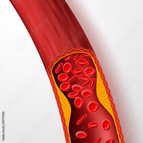 Blocked blood vessel, artery with cholesterol thrombus. 3d vein with clot vector illustration