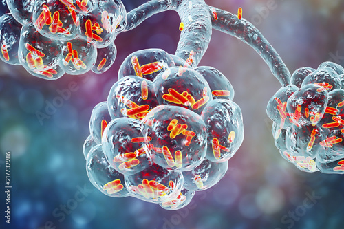 Bacterial pneumonia, medical concept. 3D illustration showing rod-shaped bacteria inside alveoli