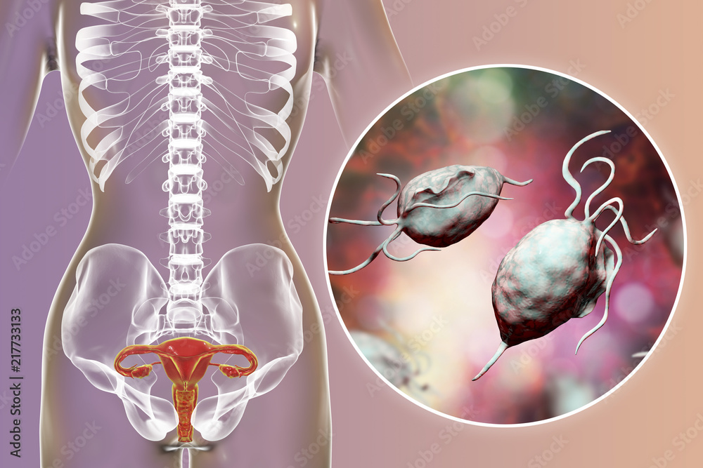 Female trichomoniasis, 3D illustration showing vaginitis and close-up
