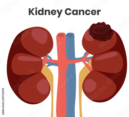 Vector illustration of the kidney cancer. The tumor is affecting left kidney while right kidney is normal photo