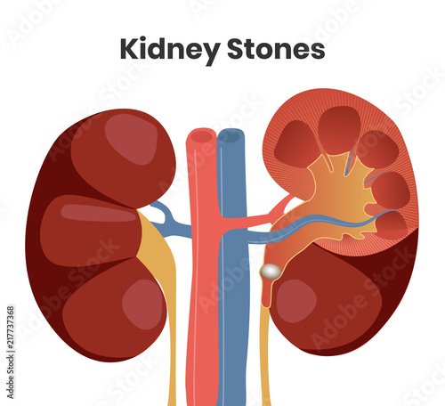 Vector illustration of the kidney stones. Obstruction of the urether with the stone