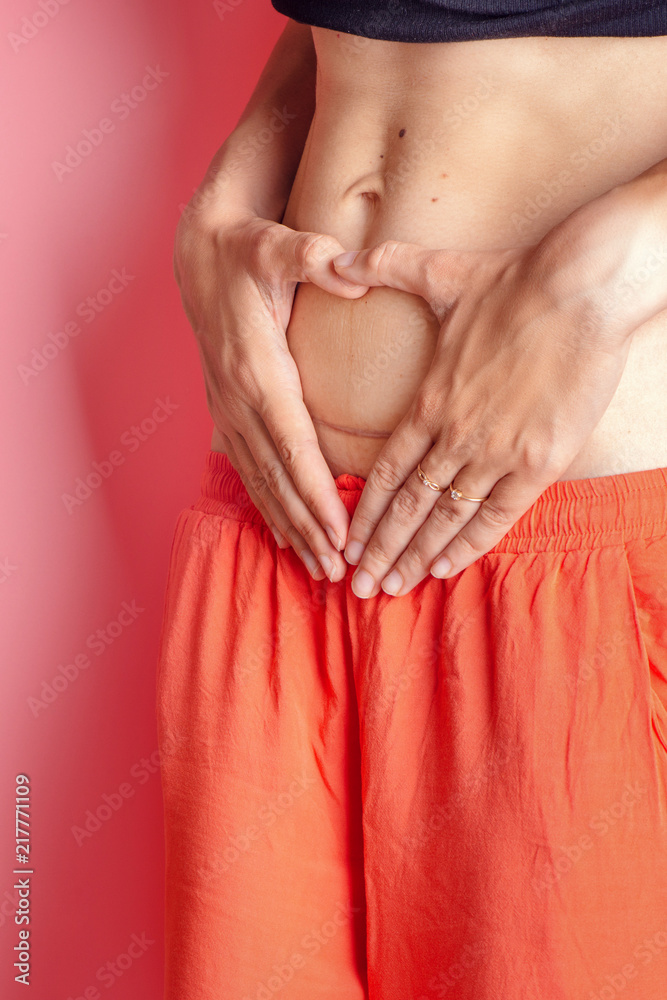 C section Cesarean operation heal after mother making heart with arms postpartum C section Cesarean operation heal after mother making heart with arms postpartum
