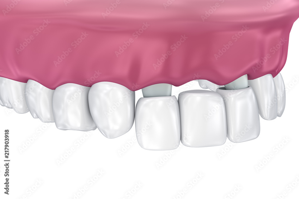 Tooth supported fixed bridge. Medically accurate 3D illustration