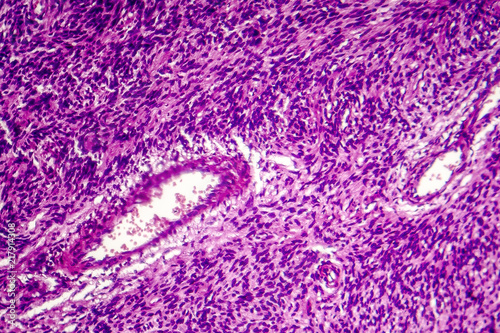 Fibrosarcoma, malignant tumor of fibroblasts, one of soft tissue sarcomas, light micrograph, photo under microscope photo