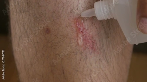 Close-up of a man's leg with an abrasion. A man treats the wound with chlorhexidine fluid from a bottle. photo