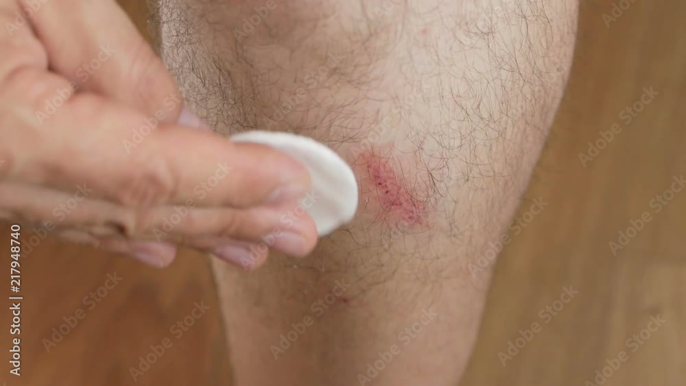 Close-up of a man's leg with an abrasion. A man treats the wound with chlorhexidine fluid from a bottle. Close-up of a man's leg with an abrasion. A man treats the wound with chlorhexidine fluid from a bottle.