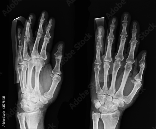 Foto X-ray of hand