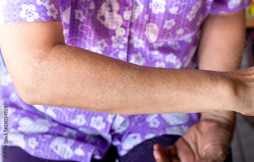 Freckles senior asian woman on her arm,Wrinkle