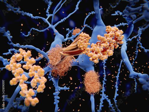 Alzheimer Krankheit: Amyloid beta Peptide lagern sich zu Amyloid-Plaques auf Neuronen zusammen. photo