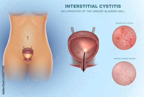 Inflammation of the urinary bladder Cystitis, interior lining closeup illustration