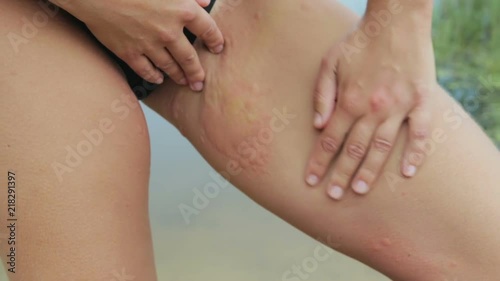 Itchy, allergic reaction, rash with blisters on the girl's thigh, she scratches her thigh, she is dressed in a black swimsuit and stands on the background of the lake, close-up