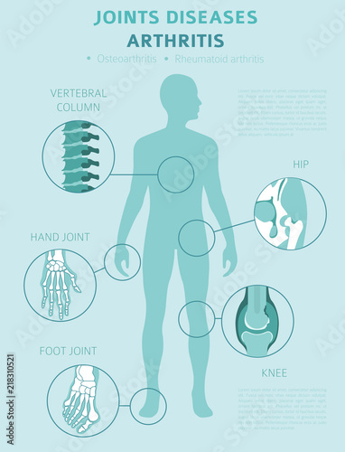 Joints diseases. Arthritis symptoms, treatment icon set. Medical infographic design