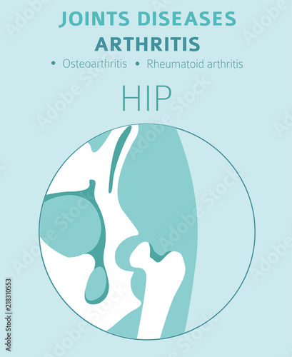Joints diseases. Arthritis symptoms, treatment icon set. Medical infographic design