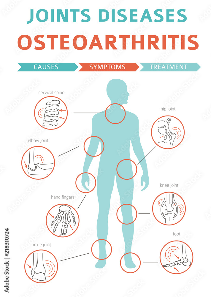Joints diseases. Arthritis, osteoarthritis symptoms, treatment icon set. Medical infographic design - obrazy, fototapety, plakaty 