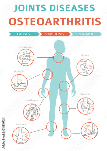 Joints diseases. Arthritis, osteoarthritis symptoms, treatment icon set. Medical infographic design