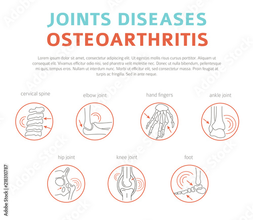 Joints diseases. Arthritis, osteoarthritis symptoms, treatment icon set. Medical infographic design