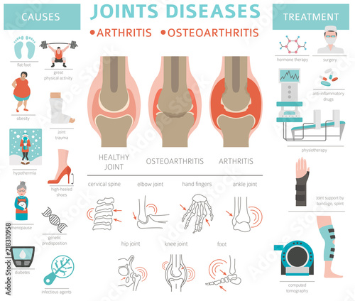 Joints diseases. Arthritis, osteoarthritis symptoms, treatment icon set. Medical infographic design photo