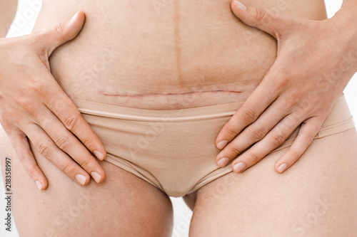 closeup of woman's belly with a scar from a cesarean section or surgery or operation photo