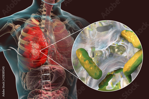 Lung infection caused by bacteria Pseudomonas aeruginosa, 3D illustration. Nosocomial pneumonia. Pneumonia in immunocompromised patients, in persons with cystic fibrosis, mucoviscidosis photo