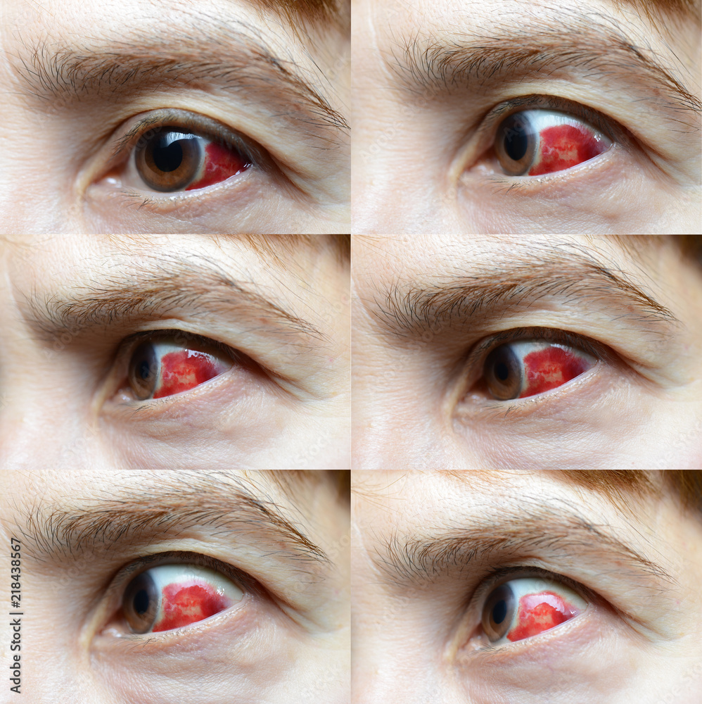 Woman with burst blood vessel in eye, closeup Stock Photo | Adobe Stock