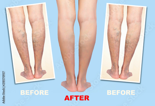 Treatment of varicose before and after. Varicose veins on the senior female legs.