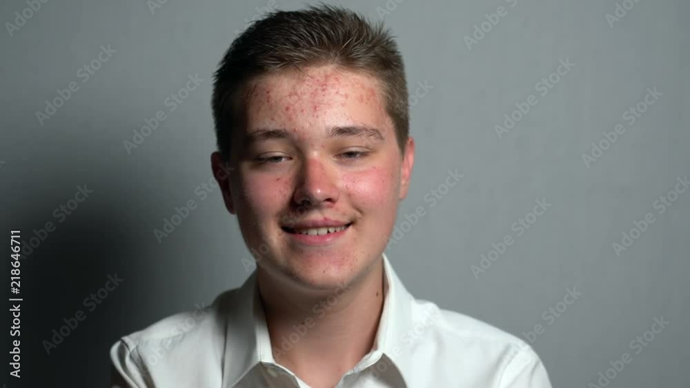 Portrait of a young happy man with a dermatology problem of skin facce looking at the camera. Dermatological problems in a teenager. Young guy in a transitional age.