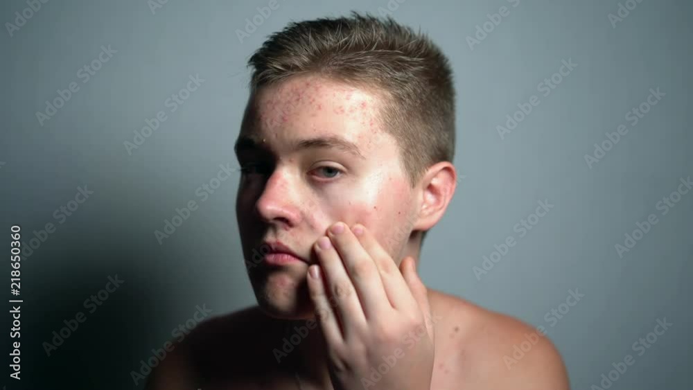 Young man with dermatology acne problems looking at the camera in the studio on the grey background. Guy smiling and touching his allergic face skin. Young man with dermatology acne problems looking at the camera in the studio on the grey background. Guy smiling and touching his allergic face skin.