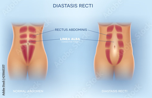 Diastasis Recti also known as Diastasis Rectus Abdominus or abdominal separation, it is common among pregnant women and post birth. There is a gap between the rectus abdominis muscles.