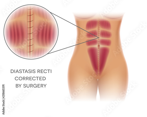 Diastasis Recti also known as Diastasis Rectus Abdominis or abdominal separation, it is common among pregnant women and post birth. After surgery correction. 