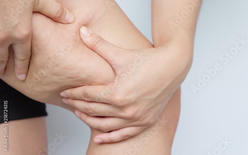 Female legs thighs with cellulite. Skin problem, body care, overweight and dieting concept, diabetic risk factor.