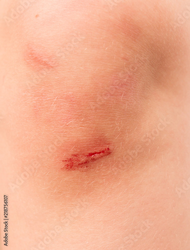 wound on the child's knee